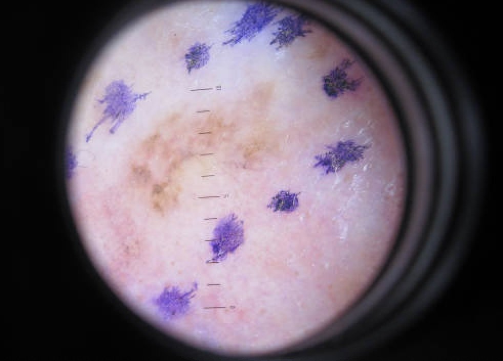 Building DeepSkin: a low-cost state-of-the-art digital dermatoscope